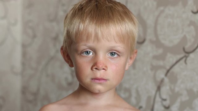 Close-up of a child's face with sunburn on the face and nose. Sunburn on baby boy's body. Portrait of a little boy with tanned skin. Children Sun protection. Sun burn.