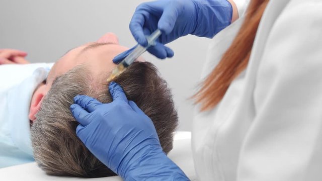 Close-up of platelet-rich plasma injections for hair loss
