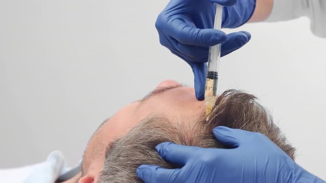 Close-up of platelet-rich plasma injections for hair regrowth