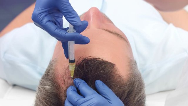Close-up shot of hair restoration prp injections