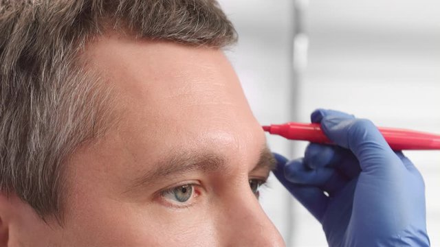 Doctor drawing correction lines on male patient's face close-up