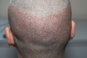 Back view of a man's head with hair transplant surgery. Bald head of hair loss treatment.