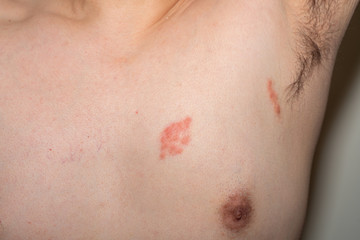 Symptom of Herpes zoster virus on chest and armpit. Detail of skin infected.