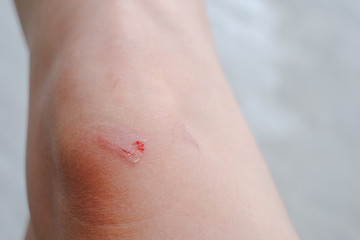 Fototapeta premium Wound at knee caused by accident, Scratches from fall.