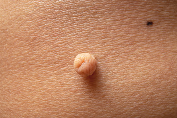 Skin Tag, Close Up Acrochondon on Female Skin. Skin Tag Removal Surgery