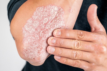 the use of emollient for dry flaky skin, as in the treatment of psoriasis, eczema and other diseases of dry skin.