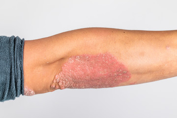 Fototapeta premium Man with sick hands, dry flaky skin on his hand with vulgar psoriasis, eczema and other skin diseases such as fungus, plaque, rash and blemishes. Autoimmune genetic disease