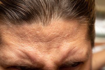 A closeup and detailed view on the forehead of a frowning woman, wrinkles are seen caused by stress...
