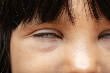 An extreme close-up view on the face of a disabled child suffering from an incurable neurological...