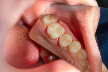 two chewing side teeth of the upper jaw after treatment of caries. Restoration of the chewing surface with a photopolymer filling material using the Rubber Dam system © Сергей Кучугурный