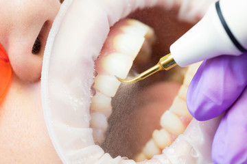 Ultrasonic teeth cleaning, close-up. Removal of tartar, plaque. Paradontitis, paradantoz.