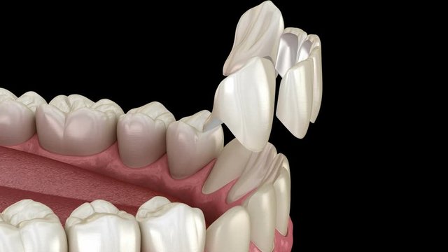 Veneer installation procedure over central incisor and lateral incisor. Medically accurate tooth 3D animation