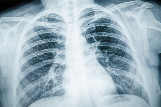 Radiographic image of the respiratory tract, lungs, ribs