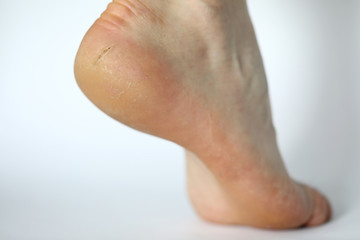 Close-up of dry leg covered with painful callous. Female heel shown in modern photography studio to expose illness. Moisturizing cream advertisement concept. Isolated on white background