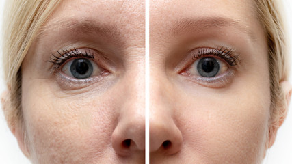 Woman face with wrinkles and age change before and after treatment - the result of rejuvenating...