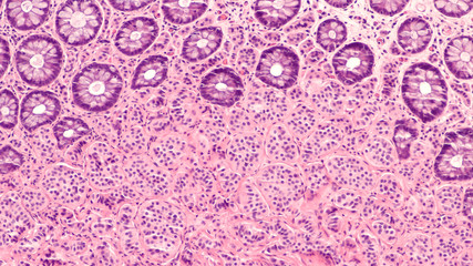 Photomicrograph of a carcinoid tumor, a type of neuroendocrine tumor (NET), which presented as a colon polyp during routine colonoscopy.  Spread to liver can cause symptoms of carcinoid syndrome.