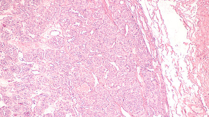 Photomicrograph of a carotid body tumor,  a paraganglioma at the carotid bifurcation.  Malignant...