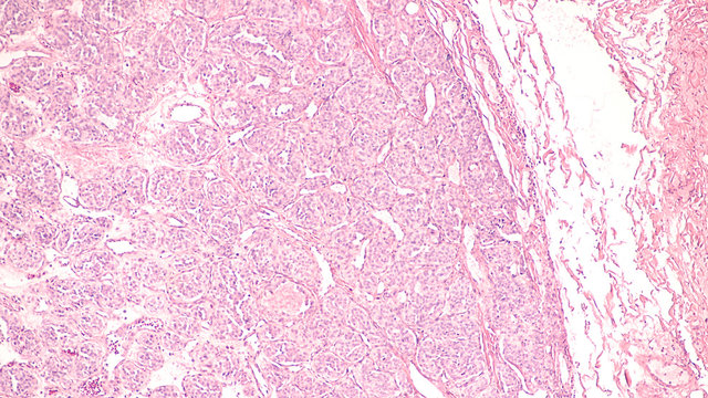 Photomicrograph of a carotid body tumor,  a paraganglioma at the carotid bifurcation.  Malignant behavior of these tumors is unpredictable.  