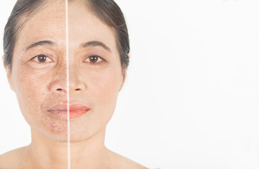 Dark spots on face . and before and after melasma  and freckles  facial treatment on face  skin...