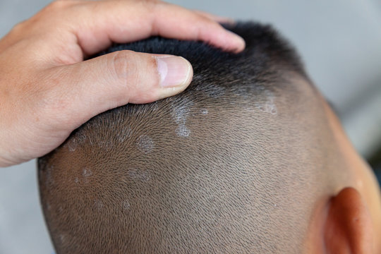 Close-up skin head , scalp, photos of dermatitis and eczema, skin problems, dermatology