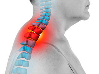 Neck pain, sciatica and scoliosis in the cervical spine isolated on white background, chiropractor...