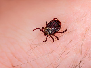 Encephalitis Virus or Lyme Borreliosis Disease Infectious Dermacentor Tick Arachnid Parasite Insect on Skin Macro