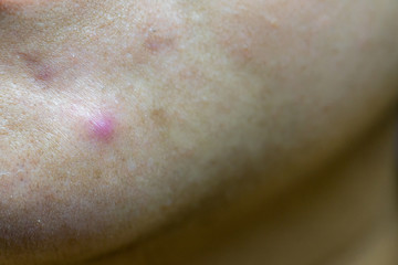 photo of nodular cystic acne skin. Chronic acne skin on woman surface.  woman with acne problem, Close up of acne on the face skin caused by the hormone and the scars