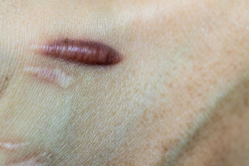 Keloid scar (Hypertrophic Scar) on man hand skin after accident. keloidal scar on wrist skin cause...