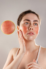Cosmetology and rosacea. The young woman runs her hands over her reddened, inflamed cheeks and rosy forehead. The enlarged image of blood vessels
