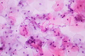 View in microscopic of Candidiasis, fungus infection (Yeast and Pseudohyphae form) in pap smear slide cytology and diagnostic by pathologist.Gynecology report and diagnosis.Medical concept.