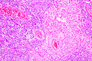 Section tissue of breast cancer view in microscopy.Ductal cell carcinoma.