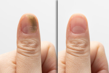 Before and after successful treatment for a fungal infection on thumb