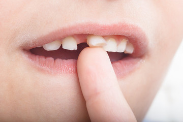 Baby tooth, close-up of the tooth that falls macro shot