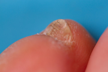 Fototapeta premium Nail infection concept image