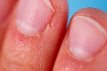 Fototapeta premium Burrs on the fingers