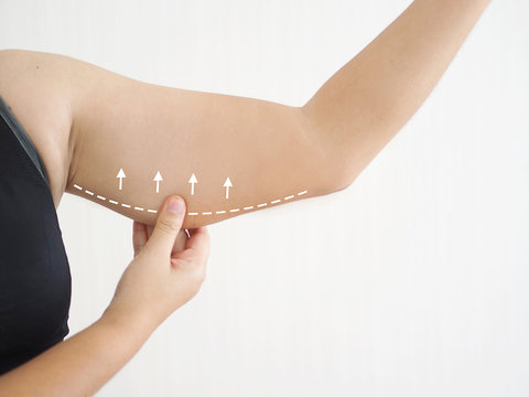 cellulite in asian woman and she grabbing her upper arm with drawing line and arrow cause of fatty from weight and loss of collagen use for body firming gel or cream product.