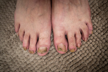 Onychomycosis with fungal nail infection two feet.