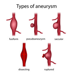 Types of aneurysm. Fusiform, pseudoaneurysm, saccular, dissecting, ruptured. Medical anatomy illustration.