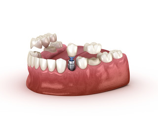 Tooth recovery with implant and crown. Medically accurate 3D illustration dental concept.