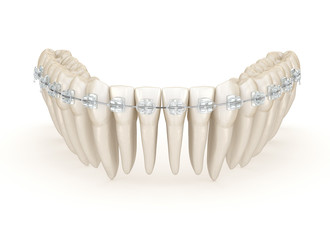 Teeth and Clear braces. 3D illustration concept