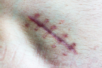 A wound on the human body, suture old, deep cut, scar close-up, incision on skin