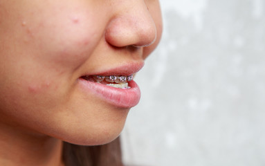 Braces to treat symptoms prognathism