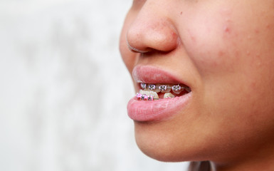 Braces to treat symptoms prognathism