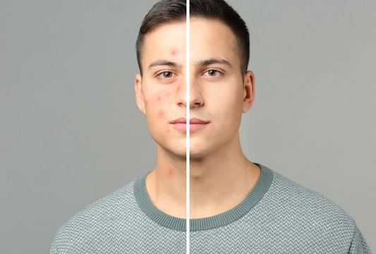 Portrait of young man with acne problem on grey background