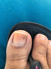 Hematoma on big toe nail