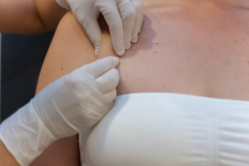 Tratamiento de eliminación de grasa