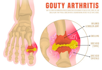 Gout arthritis infographic