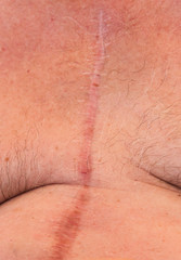 Fototapeta premium A scar from a heart operation