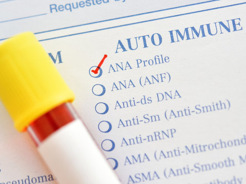 Blood Sample For Antinuclear Antibody Or ANA Test