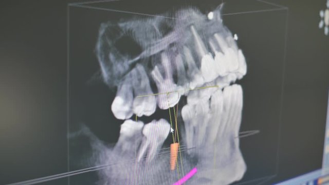 Digital radiography of dental implant